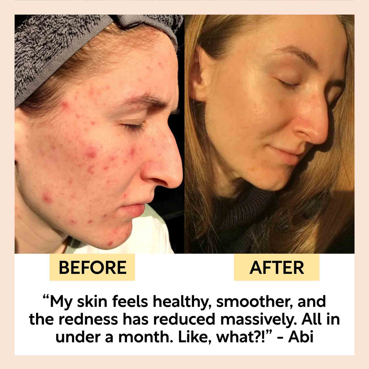 UPCIRCLE The Acne-Prone Bundle
