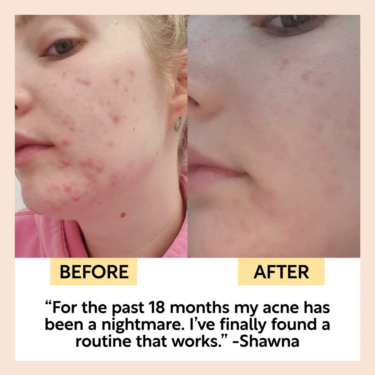 UPCIRCLE The Acne-Prone Bundle