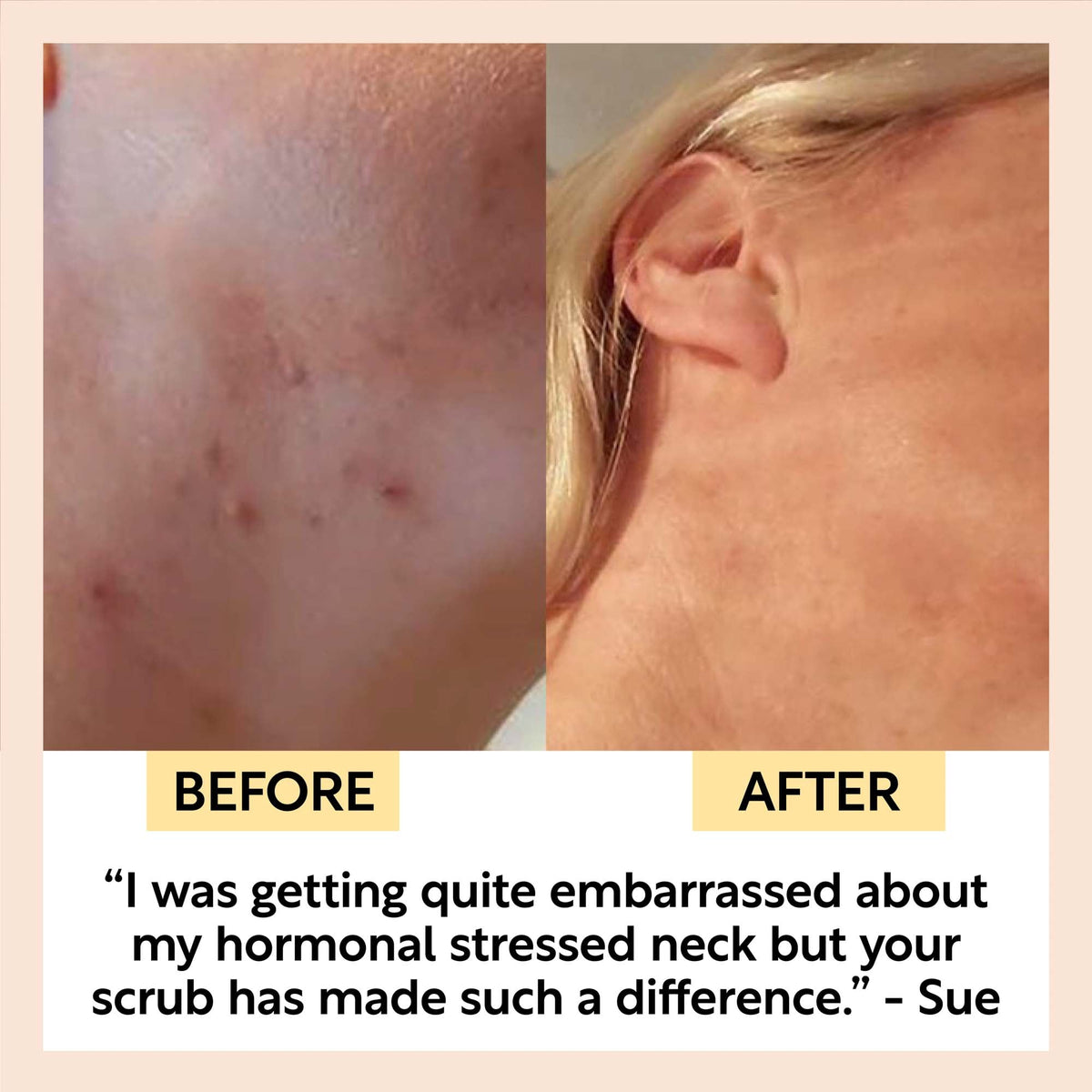 UPCIRCLE The Acne-Prone Bundle
